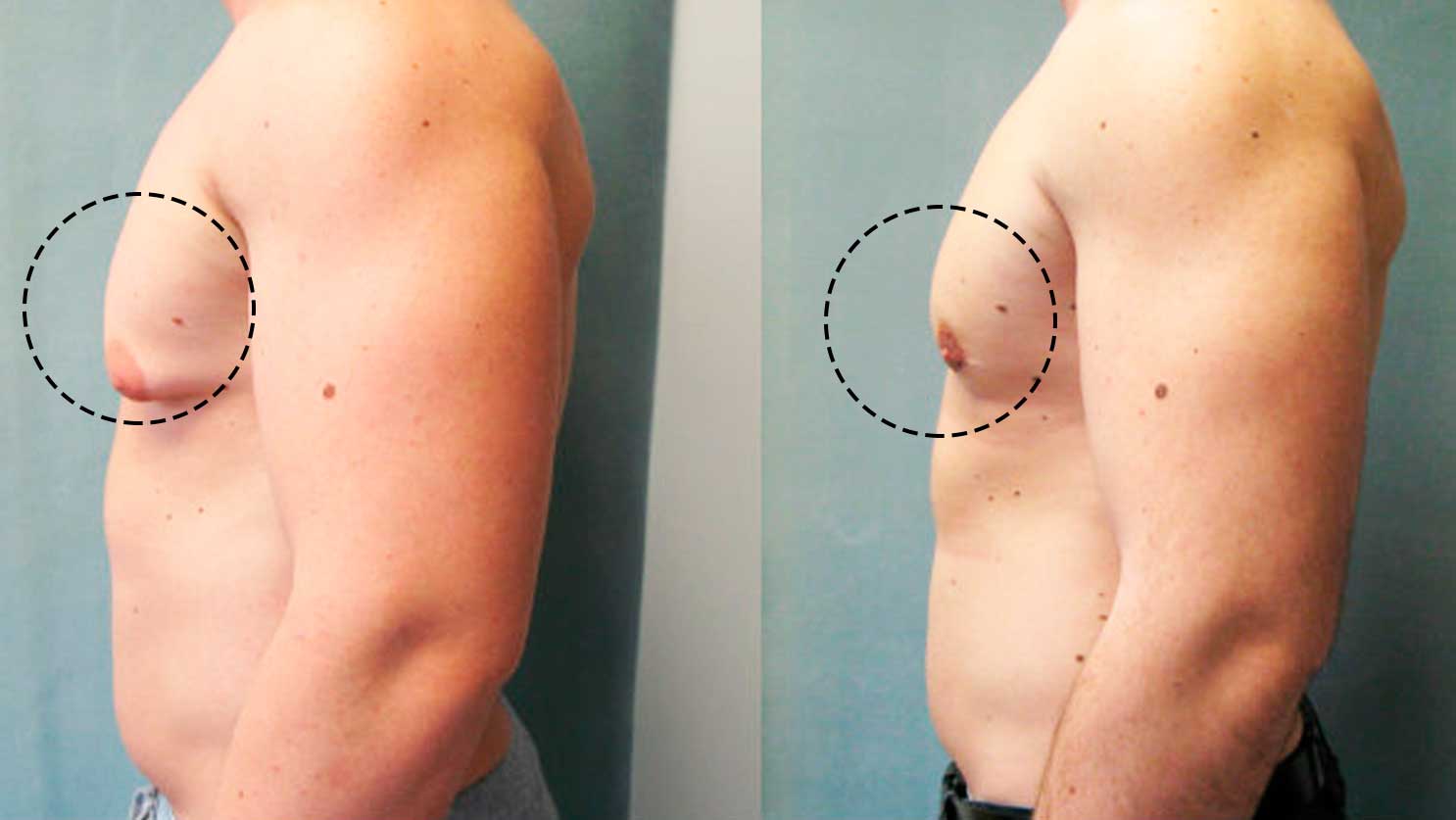 Gynecomastia
