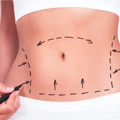 Dermolipectomia Abdominal